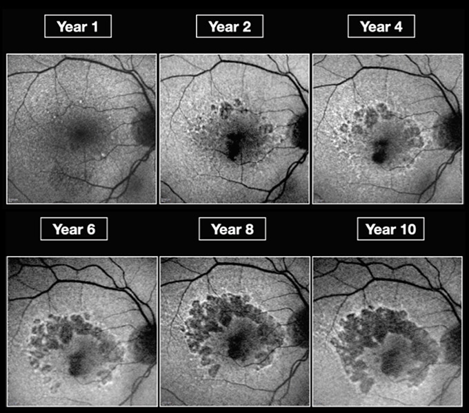 Geographic atrophy progression over 10 years, with lesions darkening and expanding.
