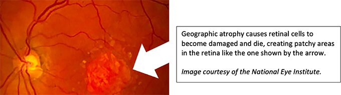 Text pointing to Geographic atrophy. Text reads: Geographic atrophy causes retinal cells to become damaged and die, creating patchy areas in the retina like the one shown by the arrow. Image courtesy of the National Eye Institute.