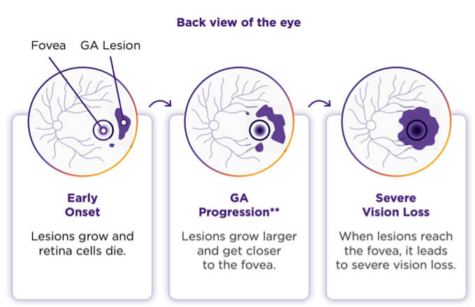 Back view of the eye showing geographic atrophy progression. Three stages labeled: Early Onset shows small purple GA lesions and dying retina cells; GA Progression shows larger lesions growing closer to the fovea; Severe Vision Loss shows large lesions covering the fovea, leading to severe vision loss.